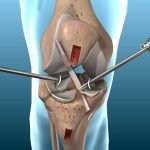 ACL Tear Surgery